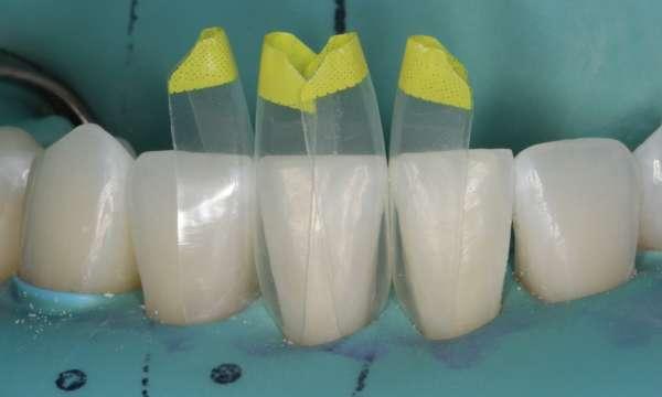 image of composite veneers in houston