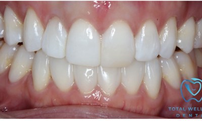 After non-invasive Bioclear black triangle closure preserving natural tooth structure and creating seamless contact between upper front teeth in Houston, TX