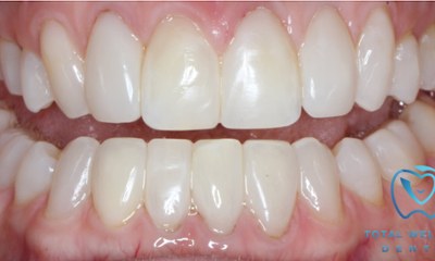 Bioclear-Smile-Rejuvenation-After-Image
