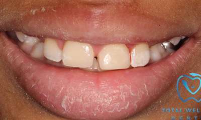 patient's smile after fixing chipped tooth