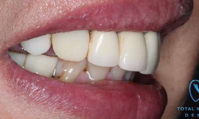 new restoration after emergency appointment