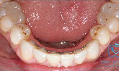 straight teeth with permanent retainer after clear aligners 