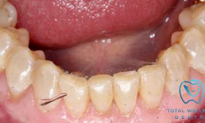 straight teeth after aligners 