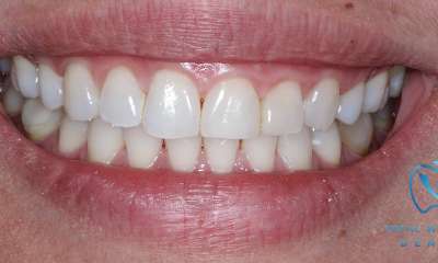 spaces closed after clear aligners 
