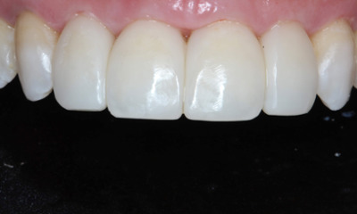 After treatment - Closing Black Triangle with Bioclear Veneers