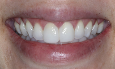 After treatment - Closing Gap with Non-invasive Bioclear Veneers