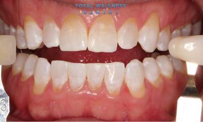 brighter smile after Kör Teeth Whitening