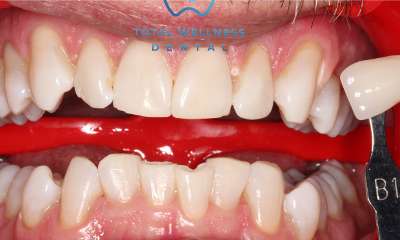 bright smile after teeth whitening