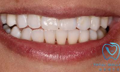 bright smile after teeth whitening