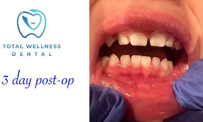 patient's gum after laser dentistry