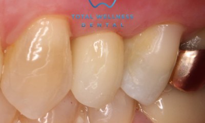 Missing-teeth-transformation-After-Image