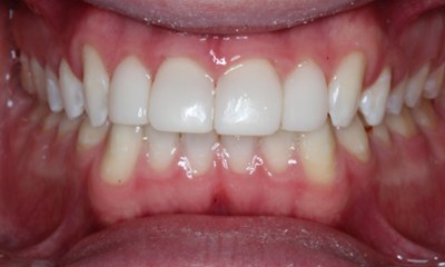 After non-invasive composite veneers enhancing tooth shape and creating a brighter, more even smile in Houston, TX