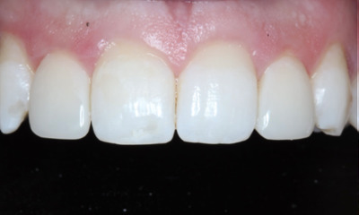 After Bioclear smile rejuvenation improving peg lateral teeth and creating a more balanced smile in Houston, TX