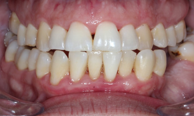 After treatment - Periodontal Therapy