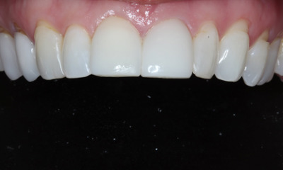 After treatment - Replaced Old Bondings with Bioclear Composite Veneers