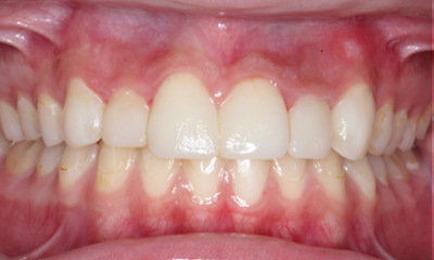 After treatment - Restoration and Rejuvenation with Non-invasive Bioclear Composite Veneers 