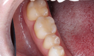 Safe-Mercury-Amalgam-Removal-Technique-SMART-After-Image
