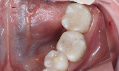 SMART-and-Bioclear-Overlay-After-Image