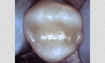 After SMART safe mercury removal with silver filling replaced by a tooth-colored composite restoration in Houston, TX