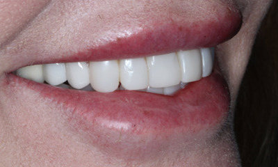 After treatment - Smile Design