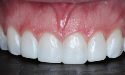 After Bioclear composite veneers creating a brighter, more balanced smile without invasive dental treatment in Houston, TX
