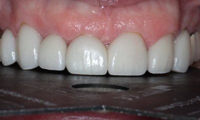 Smile-Makeover-with-Porcelain-Restorations-After-Image