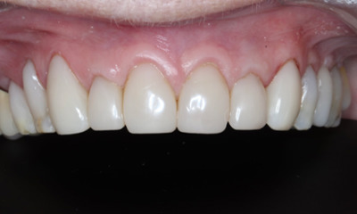 After treatment - Smile Rejuvenation with Bioclear Composite Veneers