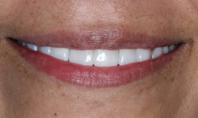 After Bioclear smile rejuvenation restoring upper front teeth and improving smile aesthetics in Houston, TX