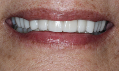 After porcelain veneers creating a brighter and more symmetrical smile at Total Wellness Dental in Houston, TX