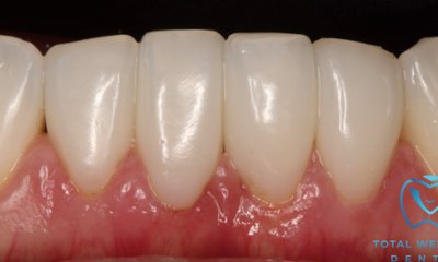 After Bioclear smile rejuvenation refining tooth shape and closing dark spaces for a smoother, more youthful smile in Houston, TX