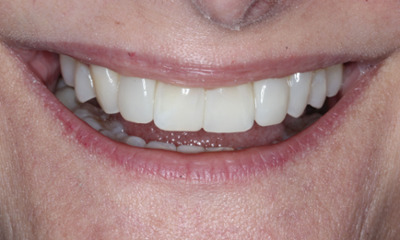 Close-up after Bioclear cosmetic treatment creating smoother tooth contours and a more natural-looking smile in Houston, TX