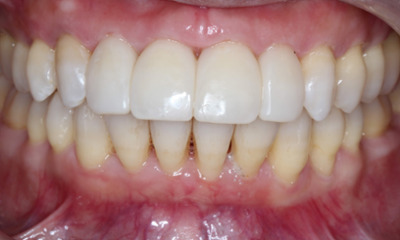 After treatment - Closing Black Triangle with Bioclear Veneers