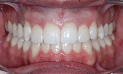 After Bioclear composite restoration enhancing peg lateral teeth and smile symmetry in Houston, TX