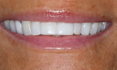 After treatment - Replaced Old Bondings with Bioclear Composite Veneers