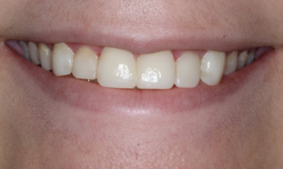 After treatment - Restoration and Rejuvenation with Non-invasive Bioclear Composite Veneers 