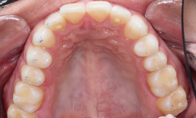 After SMART amalgam removal treatment with natural-looking composite restorations at Total Wellness Dental in Houston, TX