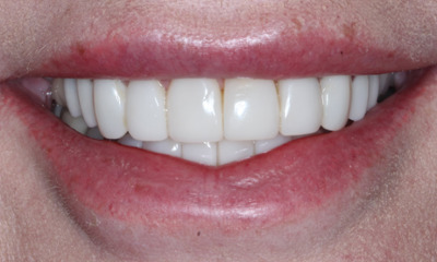 After treatment - Smile Design