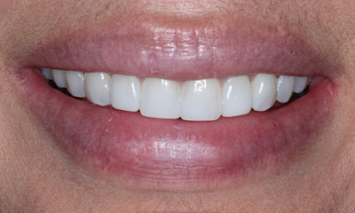 After Bioclear smile lift improving tooth shape, symmetry, and overall smile appearance in Houston, TX
