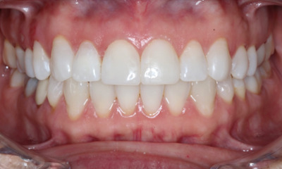 After Bioclear treatment restoring tooth shape, function, and a more youthful smile appearance in Houston, TX