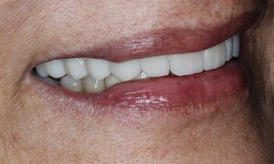 Side view after porcelain veneer treatment with improved smile balance and natural-looking results at Total Wellness Dental in Houston