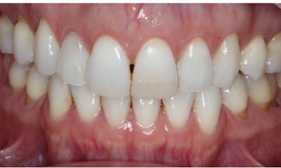 Before Bioclear black triangle closure showing visible spacing between upper front teeth in Houston, TX