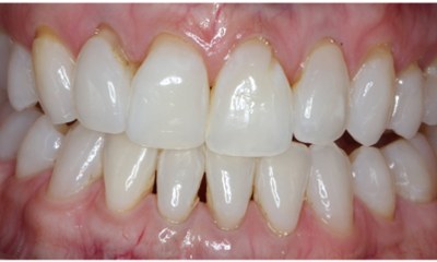 Bioclear-Smile-Rejuvenation-Before-Image