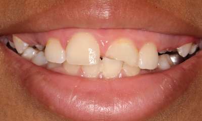 chipped tooth during dental emergency