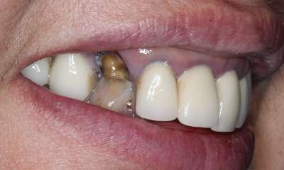 broken restoration during dental emergency