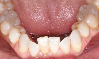 crooked bottom teeth 