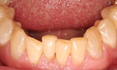 crowded teeth before aligners 
