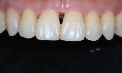 Before treatment - Closing Black Triangle with Bioclear Veneers