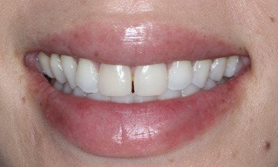 Before treatment - Closing Gap with Non-invasive Bioclear Veneers