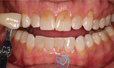 discolored teeth before whitening