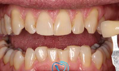 discolored teeth before whitening